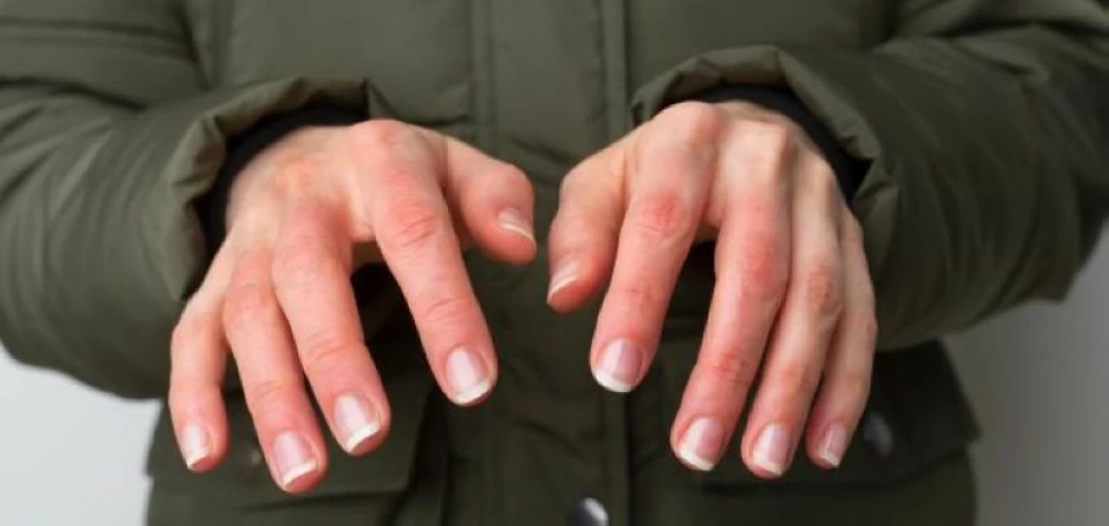 برودة اليدين والقدمين.. إنذار من الجسم لا تتجاهله