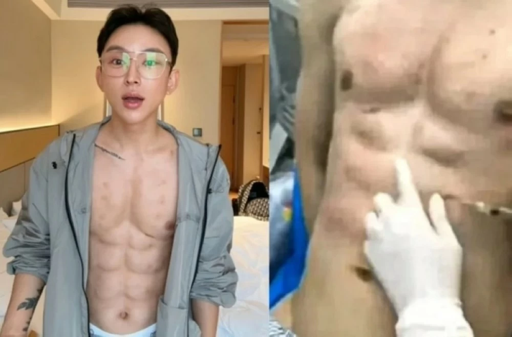 هوس الجمال في الصين.. مؤثر شهير ينفق 560 ألف دولار لتكوين عضلات بطن وهمية