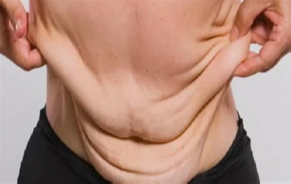 كيف تتجنب ترهل الجلد بعد التخسيس؟