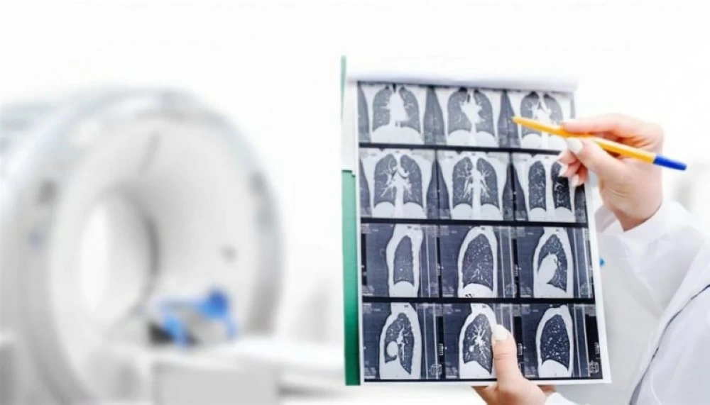 فحص مبكر واحد يُنقذ حياة الآلاف من سرطان الرئة