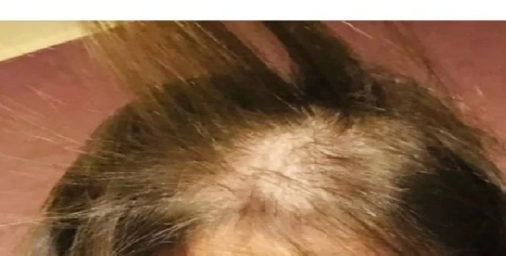 نشرت الفنانة صورة تُظهر الضرر الذي لحق بفروة رأسها وشعرها.