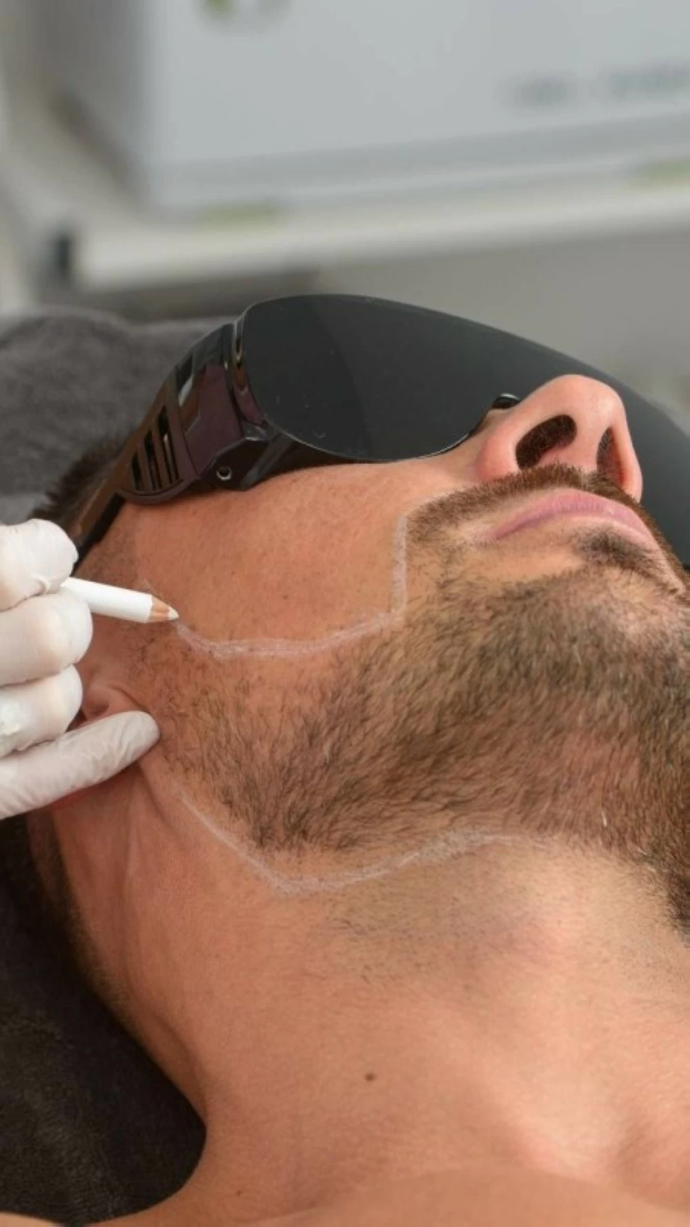 تحديد الذقن بالليزر