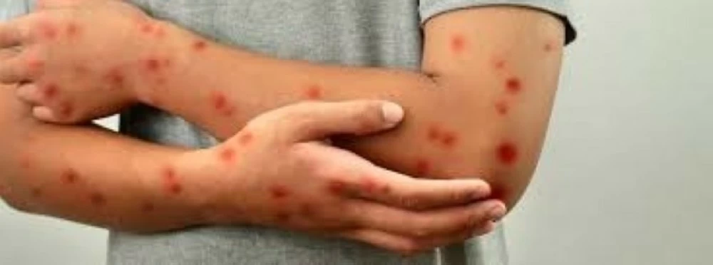 بريطانيا تكتشف سلالة مُعاد تركيبها من جدري القرود وتُحذر من تطورها