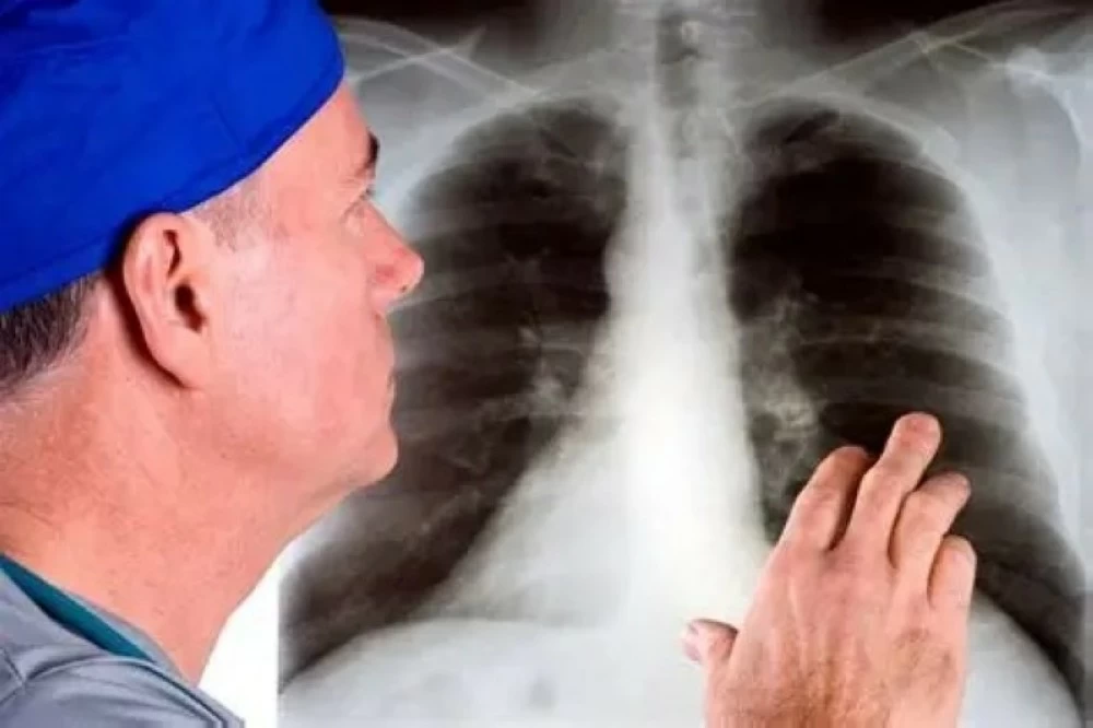 باحثون ألمان يفسرون لماذا يعود سرطان الرئة الصغير بسرعة مدمرة.