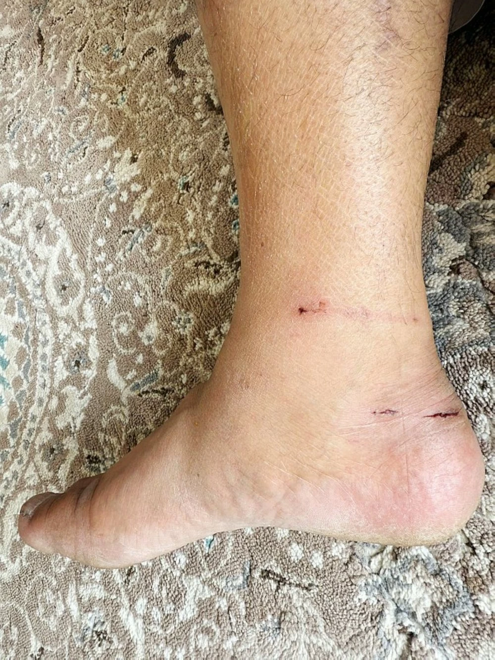 
آثار عضة الكلب في قدم وساق العتيبي. (عكاظ)   