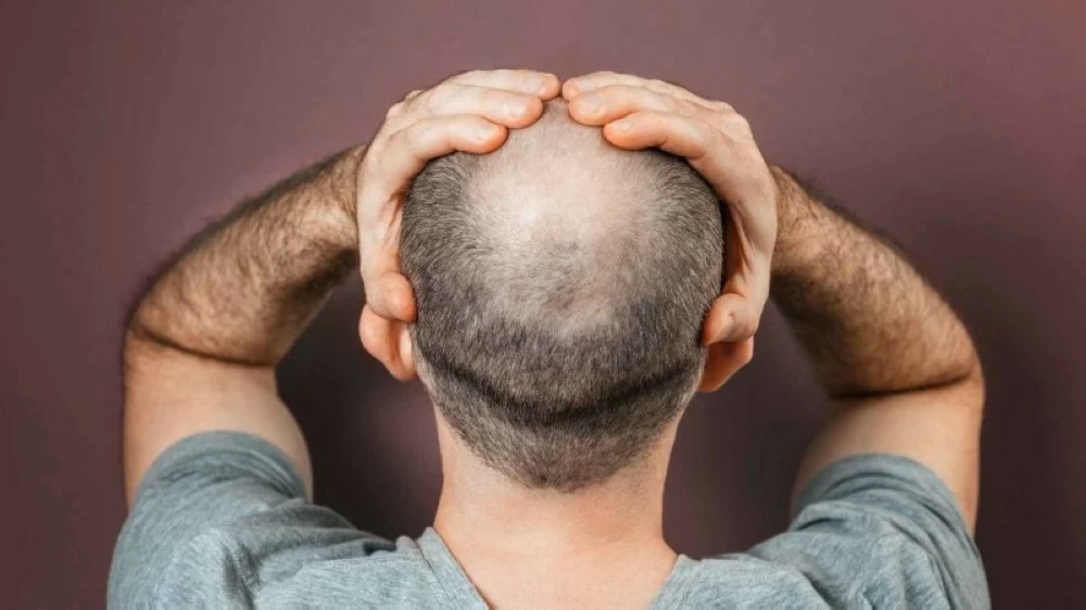 اتهام زوج بإخفاء صلعه وخداع زوجته في الهند! للاطلاع على 