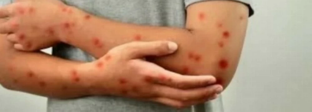 البثور اخطر علامات الاصابة بجدري القرود
