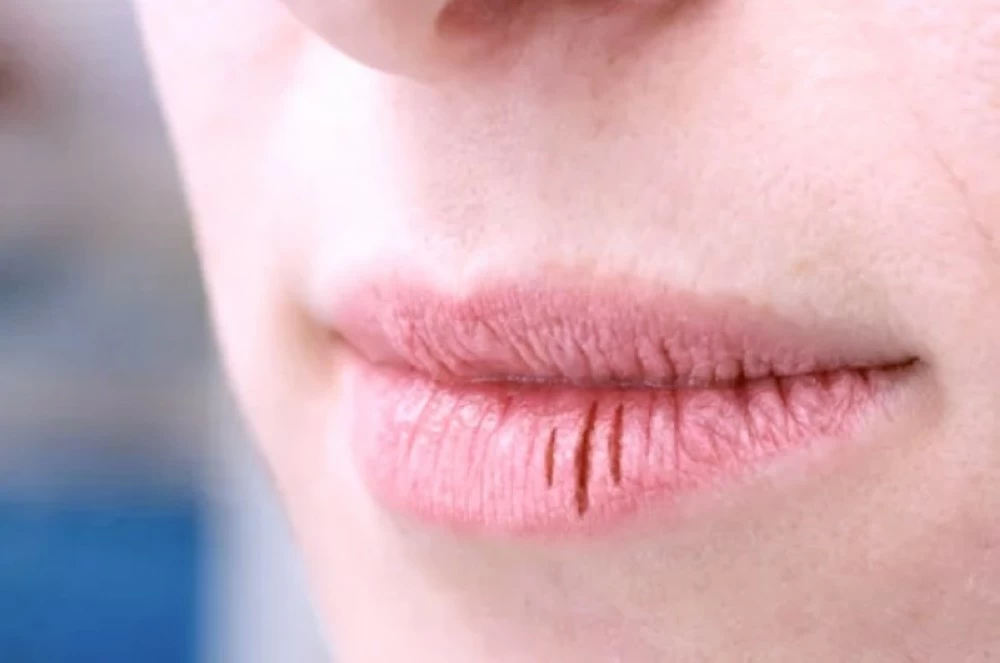 تشقق الشفاه.. مؤشر اضطرابات صحية. للاطلاع على 