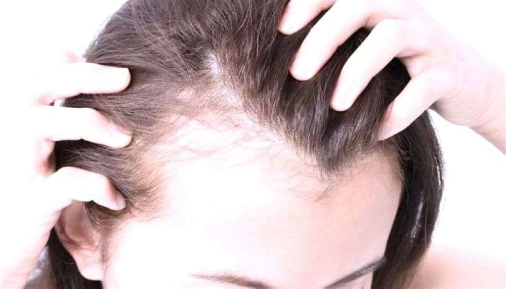 تساقط شعر النساء.. يتجاوز الجانب التجميلي. للاطلاع على 