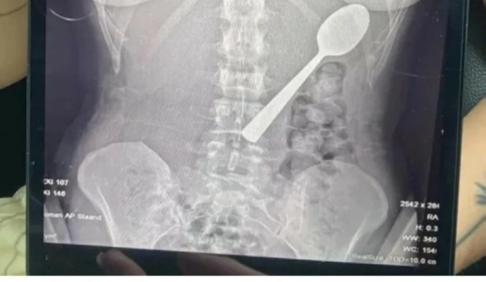 قفزة كلب تقود إلى غرفة العمليات.. شابة تبتلع ملعقة طولها 17 سنتيمتراً. للاطلاع على 