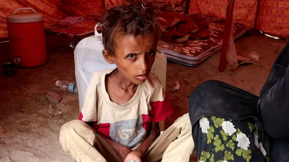  طفل نازح من الساحل الغربي مع أسرته في أحد مخيمات النزوح بمحافظة لحج، يعاني من سوء التغذية في ظل ظروف إنسانية قاسية.