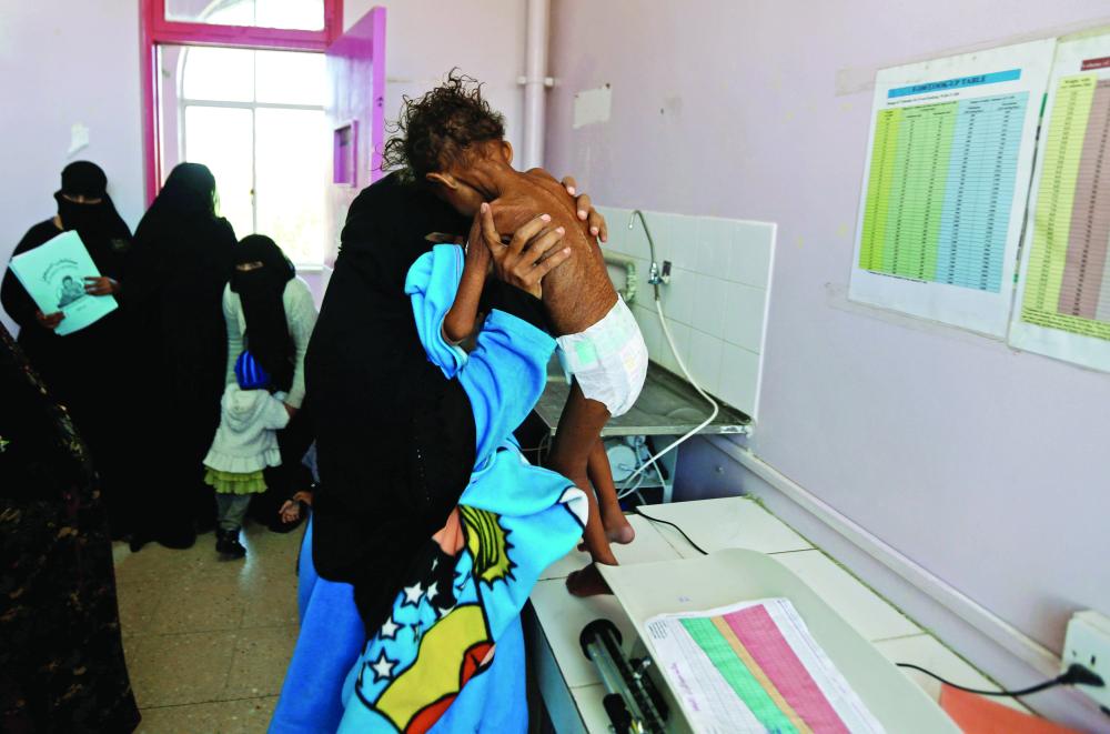طفلان يمنيان يعانيان من سوء التغذية بسبب ممارسات الانقلابيين يعالجان في أحد المراكز الطبية في صنعاء أمس. (رويترز)