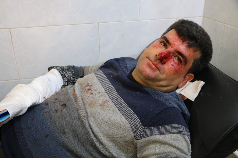 Nassib Rasheed Ali, 35, from Rajo area, northwest of Afrin, lies at a hospital bed after his hand was amputated following injuries sustained in a reported Turkish air strike, according to medical sources, in the northern Syrian Kurdish town of Afrin on January 30, 2018.

 Turkish air strikes pounded the Syrian border region of Afrin and fighting raged on two fronts as Ankara pursued its offensive against the Kurdish enclave. / AFP / Ahmad Shafie BILAL
