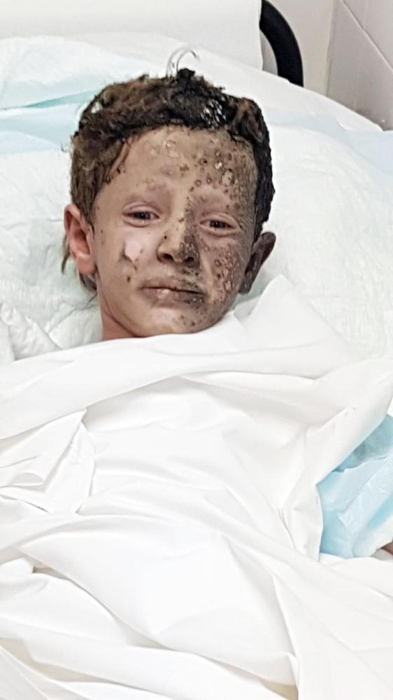 



الطفل عبدالرحمن مصاباً بحروق في 15% من جسده. (عكاظ)