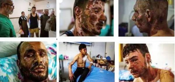 



صور لعدد من ضحايا الأسلحة المحرمة التي استخدمها نظام أردوغان خلال العدوان التركي على شمال سورية. (مجلة نيوزويك الأمريكية)