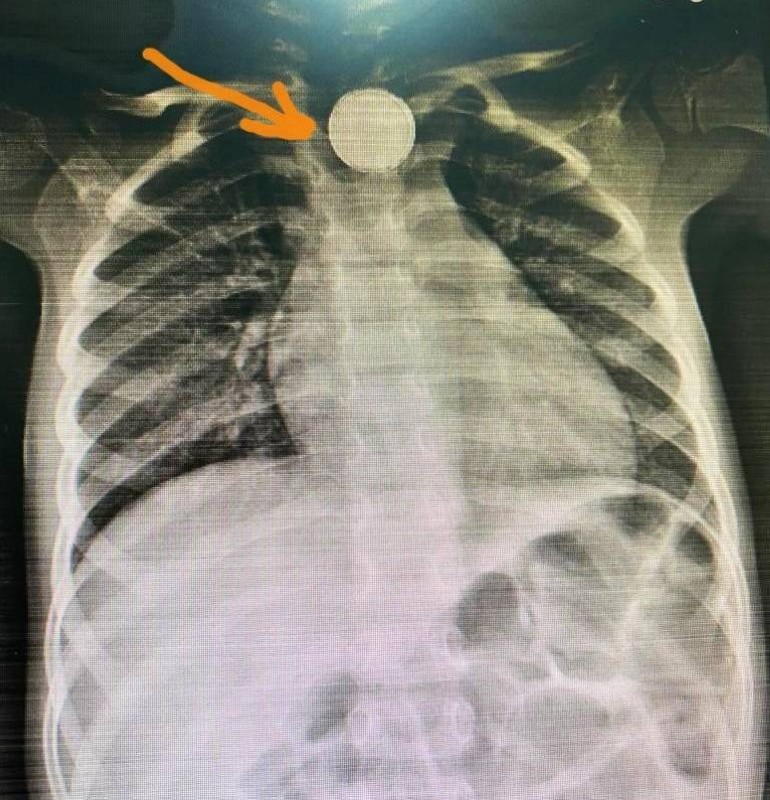 صورة أشعة تظهر البطارية في مريء الطفلة.