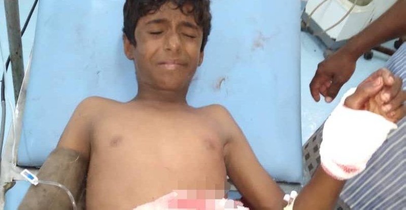 طفل مصاب في انفجار لغم حوثي في الحديدة.