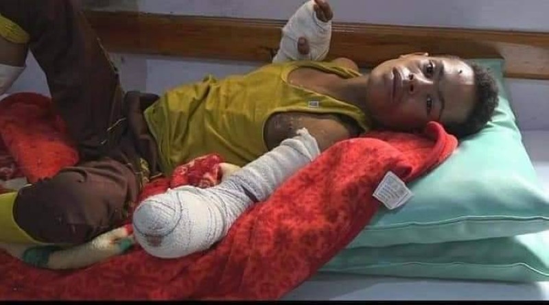 طفل يمني أصيب إلى جانب والدته وأخوانه الاثنين في قصف حوثي على قرية العبدلة غرب تعز السبت.