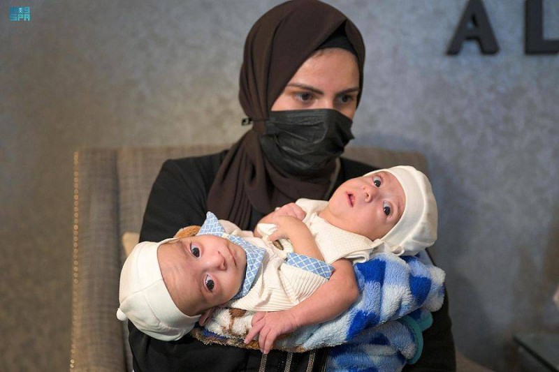 التوأم السيامي العراقي عمر وعلي مع والدتهما
