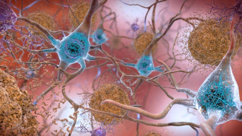 بروتين أميلويد بيتا تترسب على خلايا الدماغ (اللونان الأزرق والبنّي) لتعيق التواصل بينها، محدثة التدهور الإدراكي. (وكالات) 
