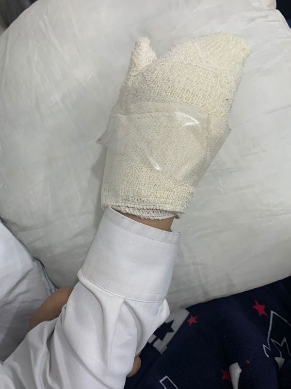 يد الفتاة بعد إصابتها بالحروق بسبب احتراق جوالها