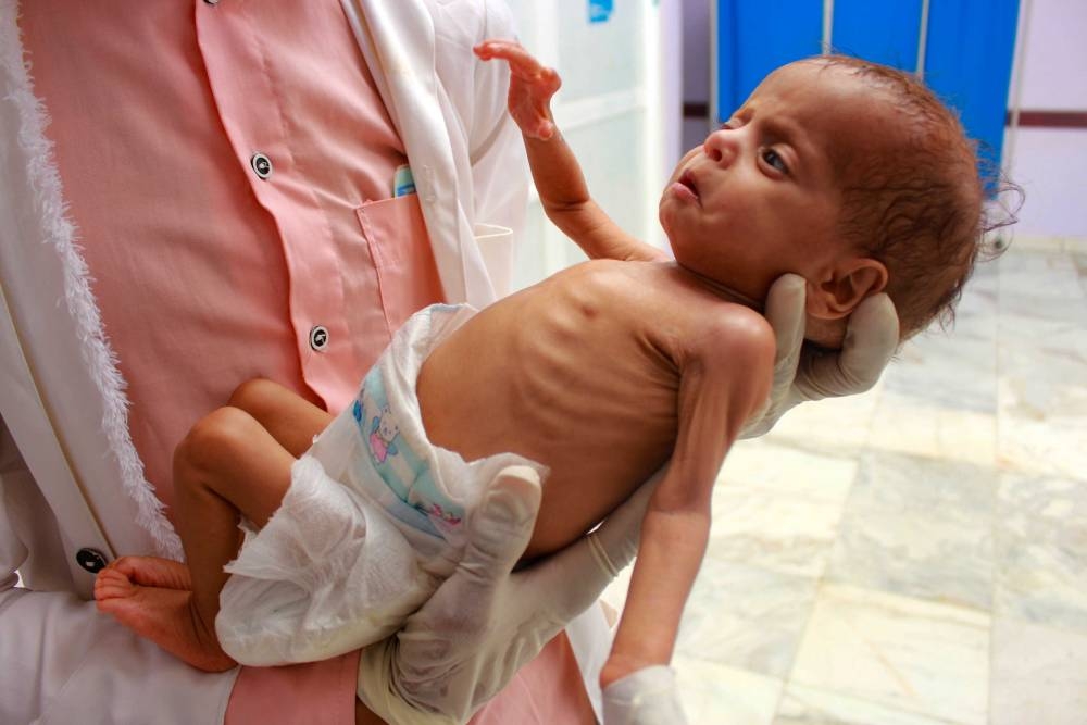 بأمراض يمكن الوقاية منها.. وفاة طفل يمني كل 13 دقيقة